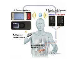 A “Bionic Pancreas” for Type 1 Diabetes?