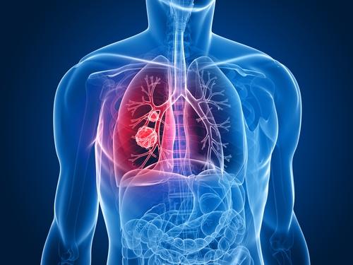 Asbestos Lung Cancer [Full Information]